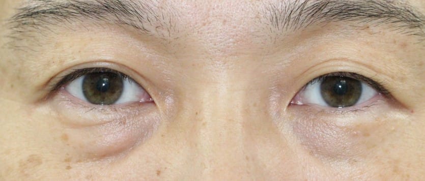 眼瞼下垂手術 デカ目手術 を行う前に知っておきたい前知識 湯田眼科美容クリニック Ry グループ