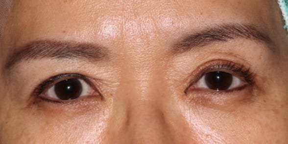 眼瞼下垂手術後 三角目 内側びっくり目 過矯正 修正 湯田眼科美容クリニック Ry グループ