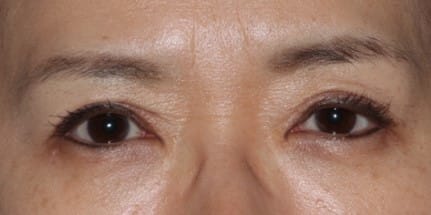 眼瞼下垂手術後 三角目 内側びっくり目 過矯正 修正 湯田眼科美容クリニック Ry グループ