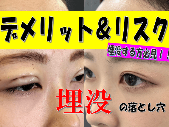 二重埋没法の目やまぶたへの負担 ダメージ について 湯田眼科美容クリニック Ry グループ