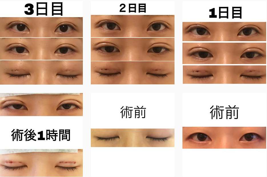 二重整形の腫れのピークはいつか 写真付きで美容外科医が解説 湯田眼科美容クリニック