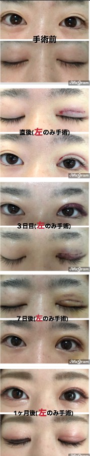 二重整形を片目ずつ もしくは片目だけやることは可能なのか 美容外科医湯田が詳説します 湯田眼科美容クリニック Ry グループ